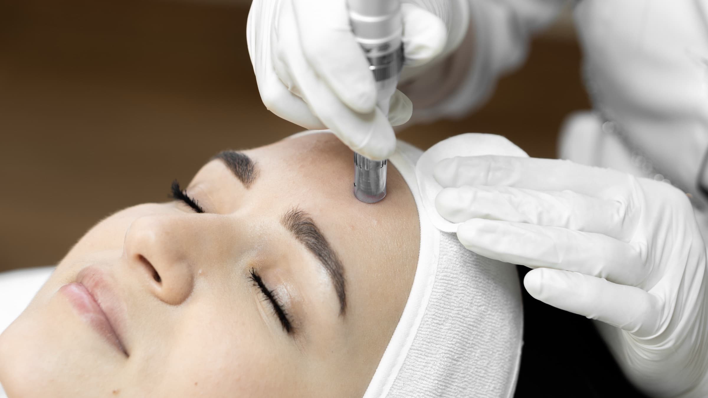 SkinPen microneedling